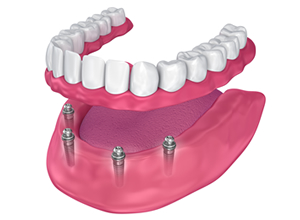 オールオン４と総入れ歯のメリット・デメリット