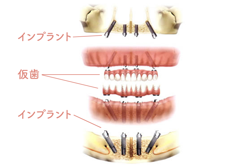 インプラント埋入イメージ