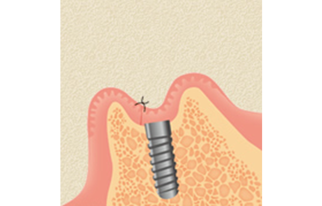 インプラント埋入 イメージ
