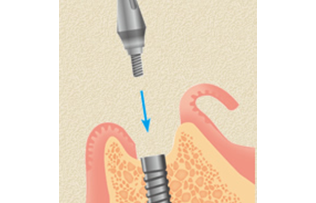 アバットメント装着 イメージ