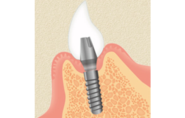インプラント手術完了 イメージ