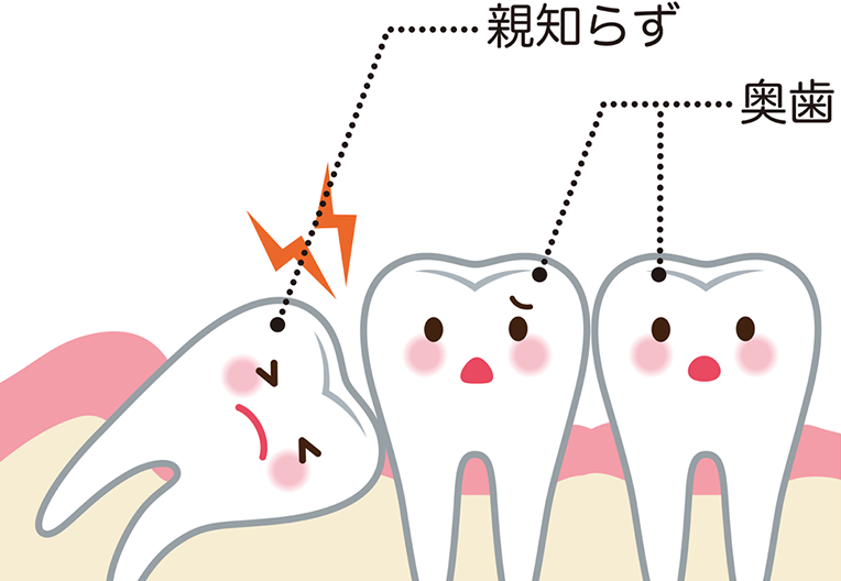 親知らずイメージ