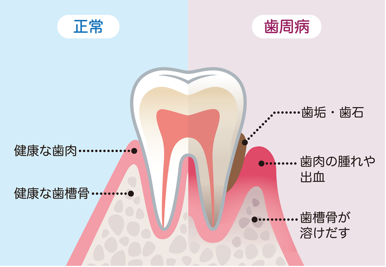 歯周病イメージ